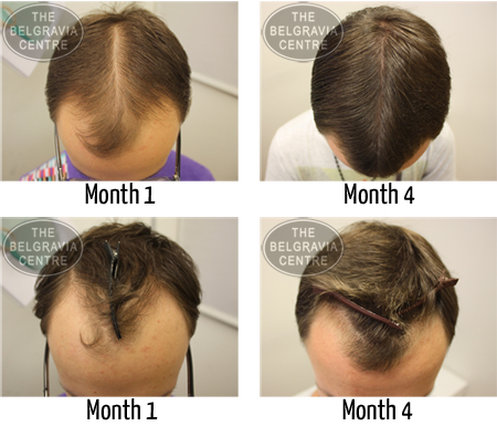 Hair Loss Treatment- The Right Way