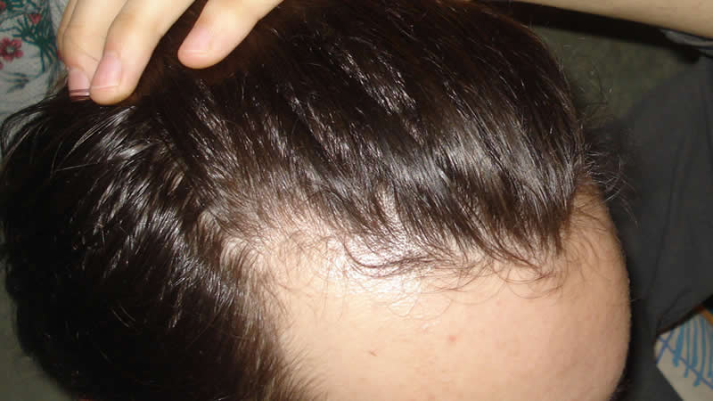 regrow hair on receding hairline