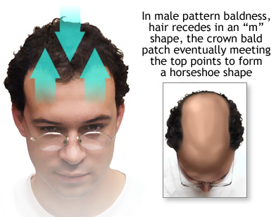 hairline receding baldness hairloss miniaturization finasteride varies outlook