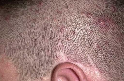 Thinning Hair And Itchy Scalp