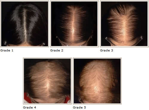 Alopecia Hair Loss  Skin Disorders  MSD Manual Consumer Version