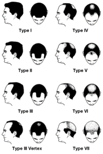 Stages Types Receding Hairline Norwood Scale 