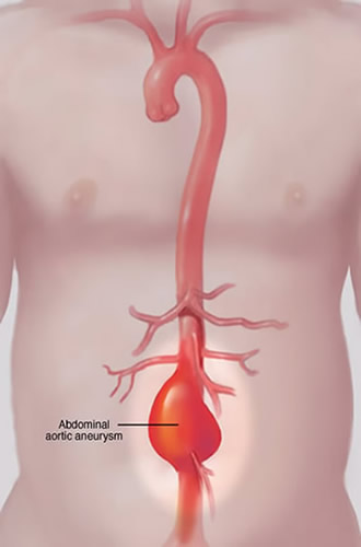abdominal_aortic _neurysm